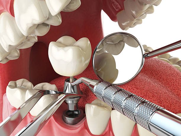 Best Emergency Wisdom Teeth Removal in Munfordville, KY